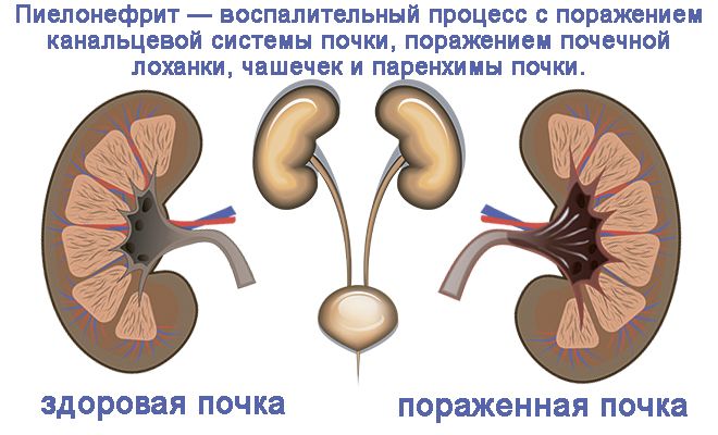 Пиелонефриты