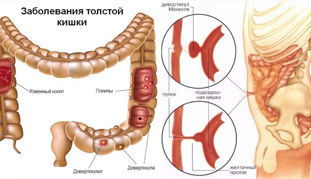 Дивертикулит