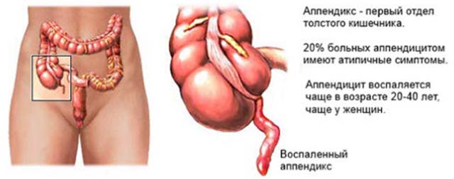 Воспаление аппендикса