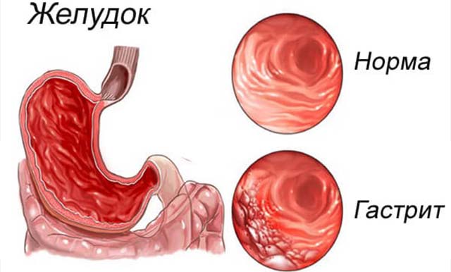 Гастрит