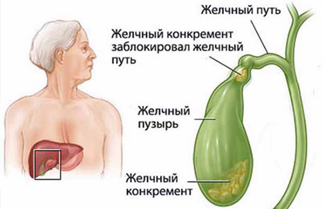 Желчная колика