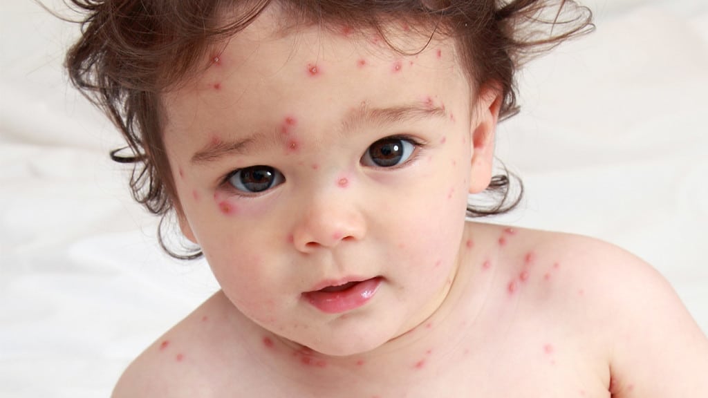 chickenpox in children