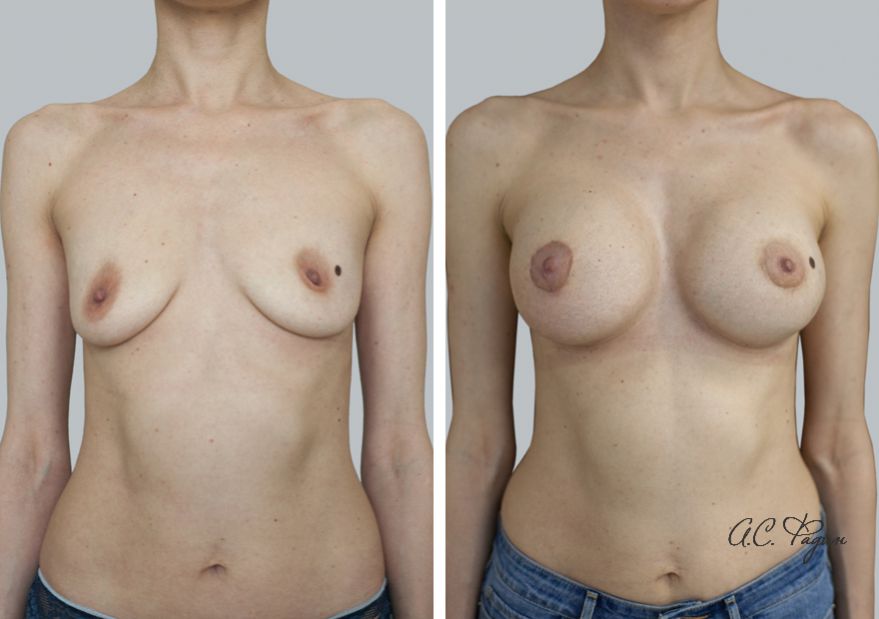 Увеличение груди имплантатами с применением липофилинга