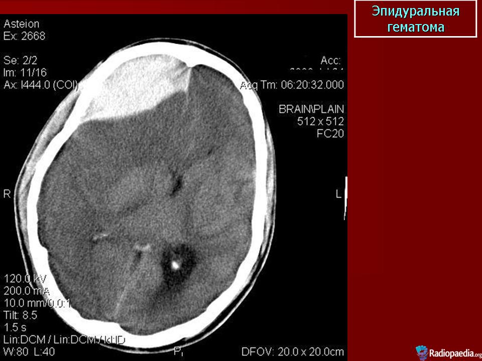 Гематома мозга операция
