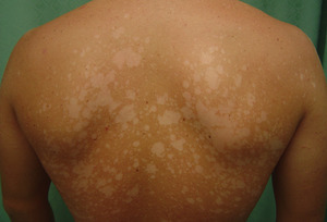 Белый лишай – заболевание кожи неизвестного происхождения, сопровождающееся специфическими симптомами