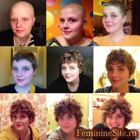когда вырастут волосы после химиотерапии