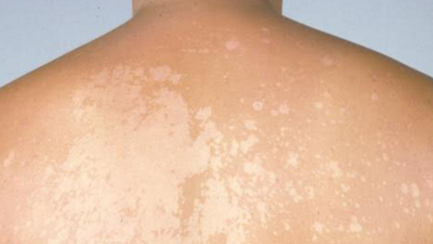 Tinea Versicolor white spots on the back