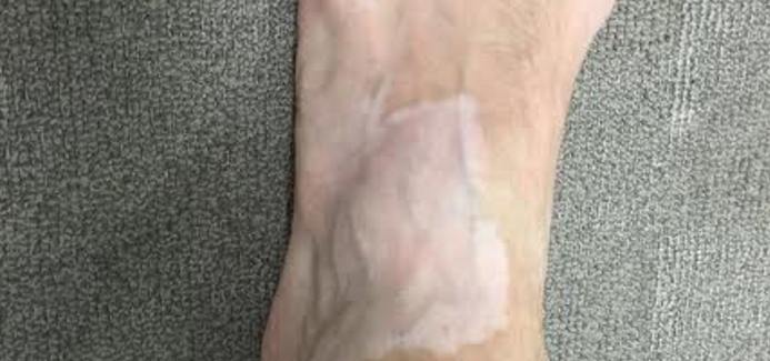 Developed vitiligo spot on the feed