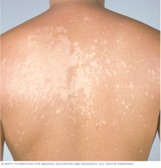 White spots on the skin caused by Tinea Versicolor
