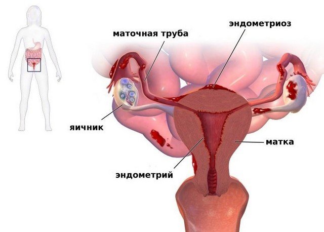Эндометриоз матки необходимо сразу же лечить, чтобы женщине не пришлось страдать от осложнений