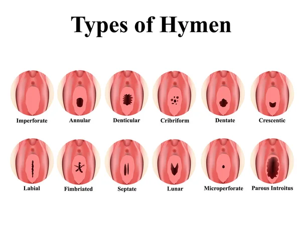 Types of hymen. Imperforate, annular, Denticular, Cribriform, dentate, Crescentic, Labial, Fimbriated, Septate, lunar, Microperforate. Hymen after defloration. Infographics. Vector illustration. Stock Vector