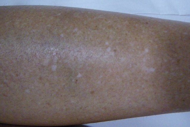 White freckles on the leg