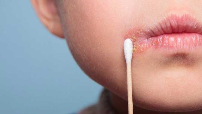 Простуда на губах: как избавиться быстро в домашних условиях