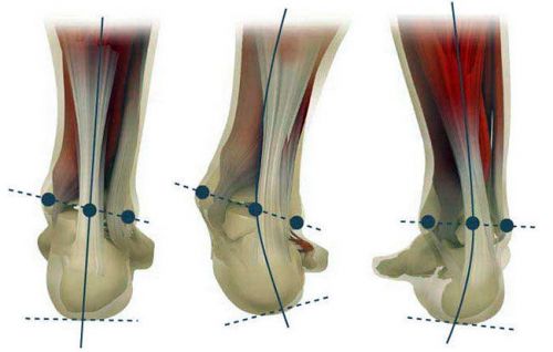 Деформация голеностопа