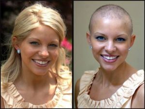 Девушка до и после химиотерапии