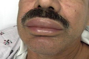 angioedema