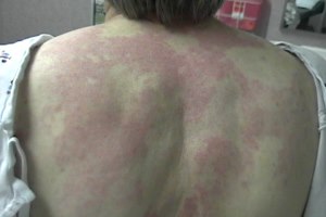 hives urticaria