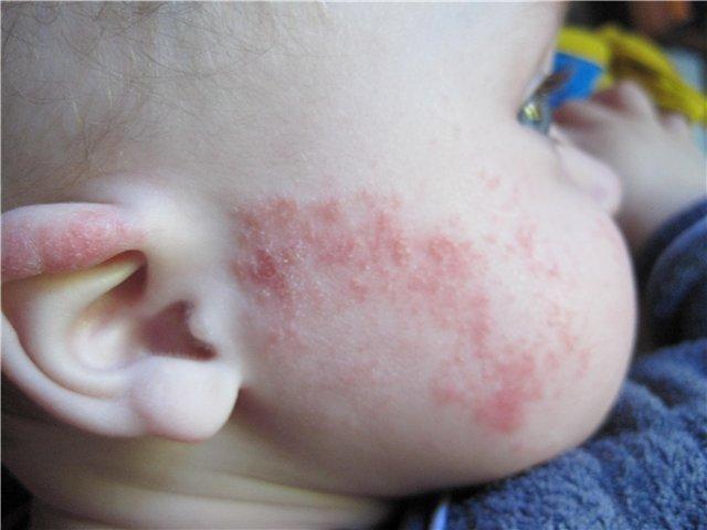 Виды аллергии у детей