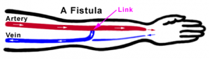 A Fistula