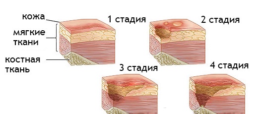 Стадии трофических язв