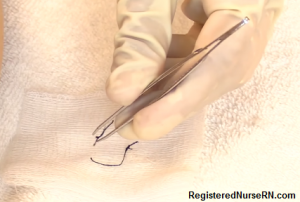 removing sutures, suture removal