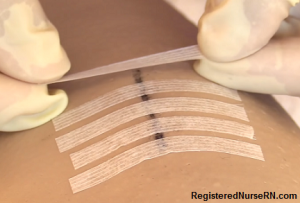 steri strips, suture removal