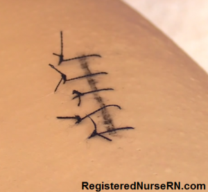 removing sutures, suture removal nursing, how to remove sutures