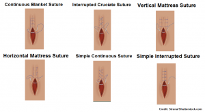 suture patterns, nursing, simple interrupted, continuous blanket, cruciate, vertical mattress, horizontal mattress