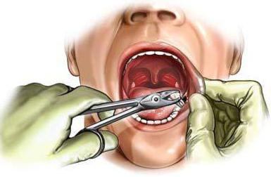 можно ли полоскать рот после удаления зуба 