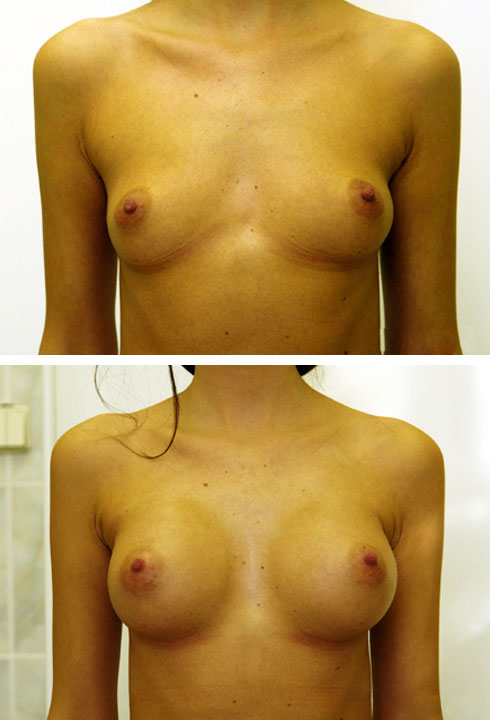 Увеличение груди фото до и после