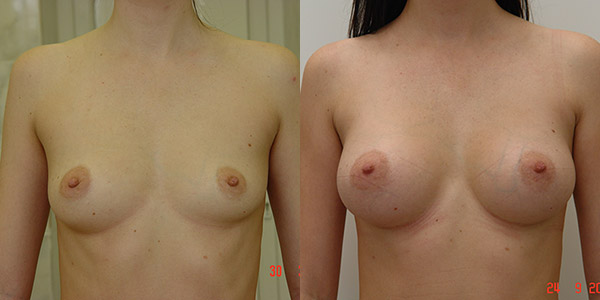 Увеличение груди фото до и после, хирург В.Г. Якимец