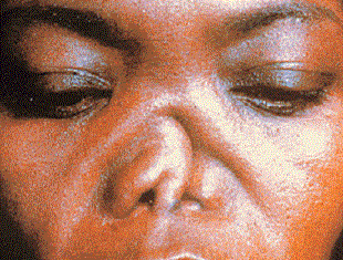 Деформация носа при лепре