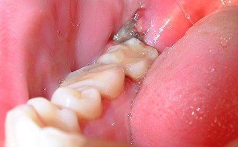 Воспаление десны на зубе мудрости